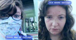 Split screen: me wearing a mask outside college on my first day (left), me six weeks earlier in hospital with a head injury (right)